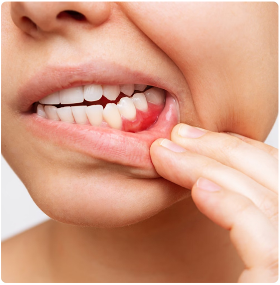 BRUXISM TREATMENT