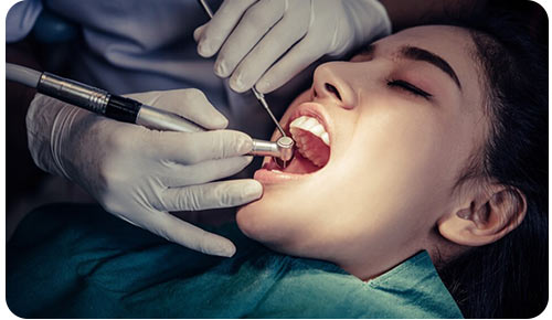 COMPOSITE FILLINGS