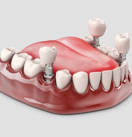 dental implant