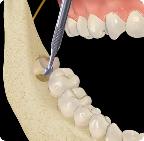 TOOTH EXTRACTION