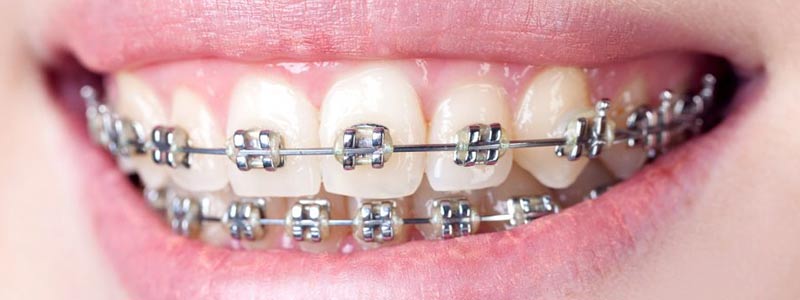 Dental Orthodontic