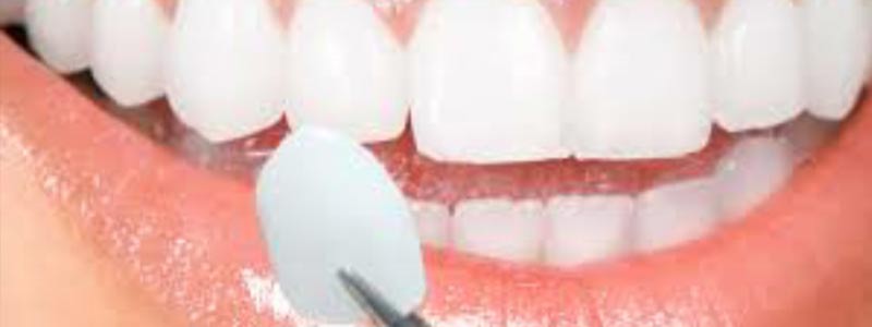 Dental Veneers / Laminates