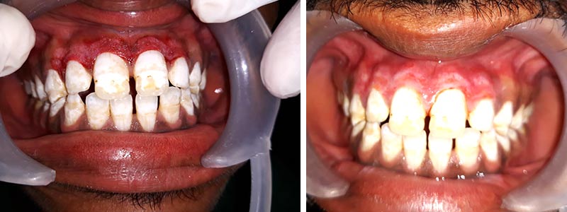 Dental Gum Depigmentationm