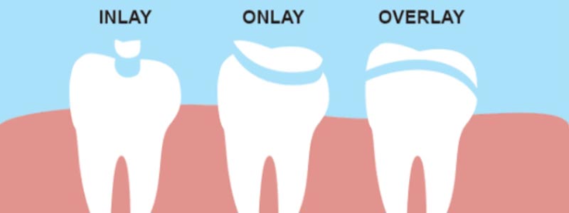 DentalInlays or Onlays