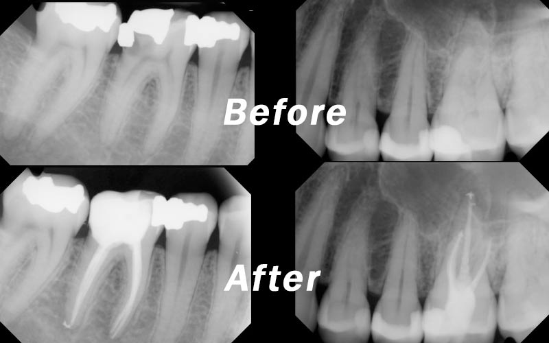 Dental Root Canal Treatment
